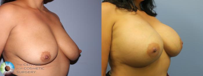 Before & After Breast Augmentation Case 11655 Right Oblique in Denver and Colorado Springs, CO