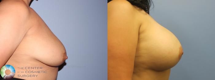 Before & After Breast Augmentation Case 11655 Right Side in Denver and Colorado Springs, CO