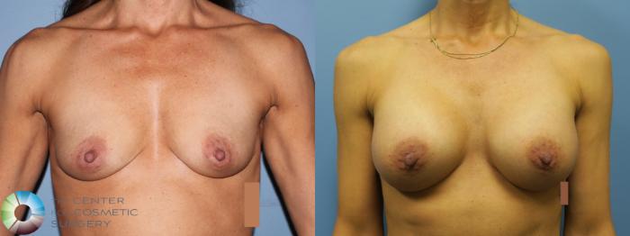 Before & After Breast Augmentation Case 11656 Front (1 year) View in Golden, CO