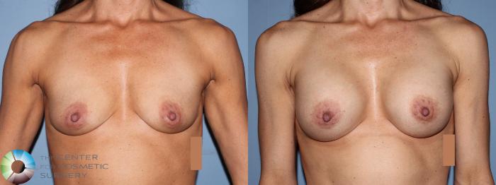 Before & After Breast Augmentation Case 11656 Front View in Golden, CO