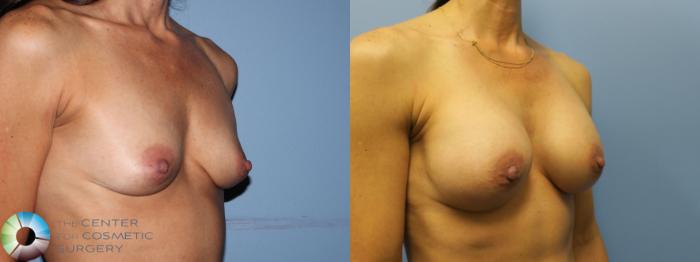 Before & After Breast Augmentation Case 11656 Right Oblique (1 year) View in Golden, CO