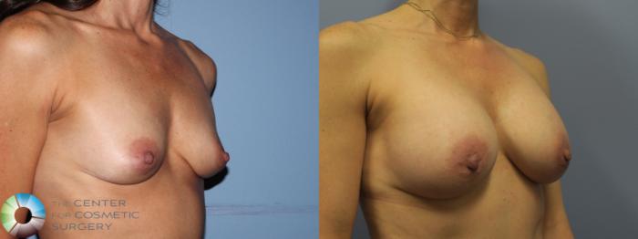 Before & After Breast Augmentation Case 11656 Right Oblique (5 years) View in Golden, CO