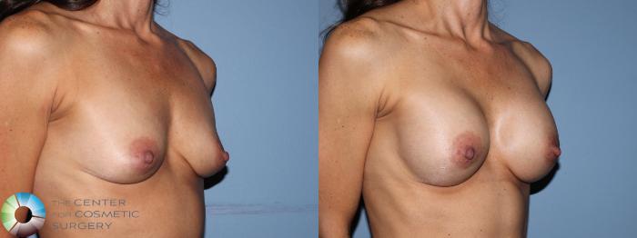 Before & After Breast Augmentation Case 11656 Right Oblique View in Golden, CO