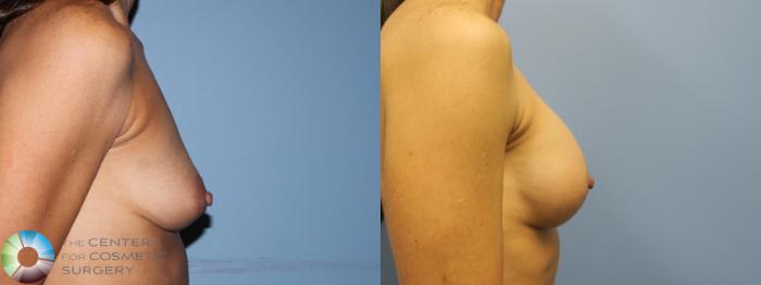 Before & After Breast Augmentation Case 11656 Right Side (1 year) View in Golden, CO