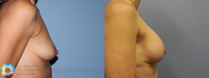 Before & After Breast Augmentation Case 11656 Right Side (5 years) View in Golden, CO