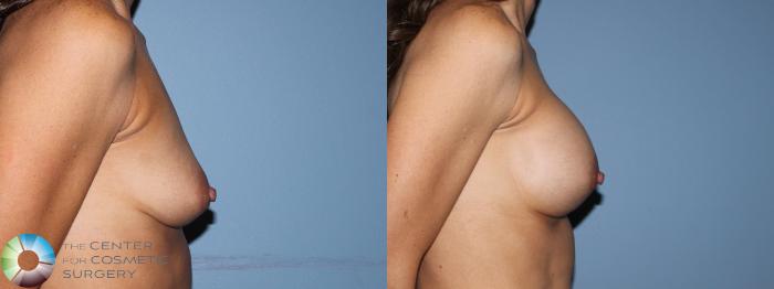Before & After Breast Augmentation Case 11656 Right Side View in Golden, CO