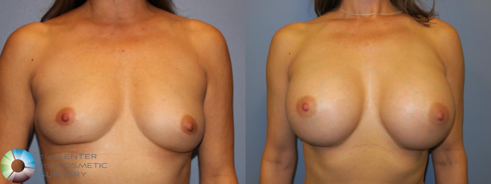 Before & After Breast Augmentation Case 11659 Front in Denver and Colorado Springs, CO