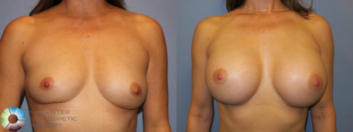 Before & After Breast Augmentation Case 11659 Front View in Golden, CO
