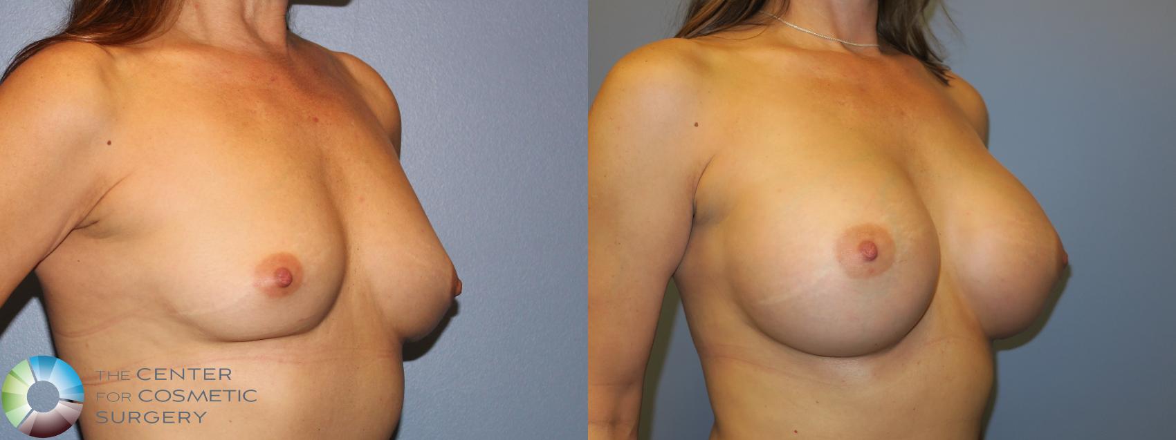 Before & After Breast Augmentation Case 11659 Right Oblique View in Golden, CO