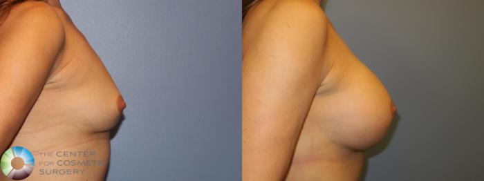 Before & After Breast Augmentation Case 11659 Right Side View in Golden, CO