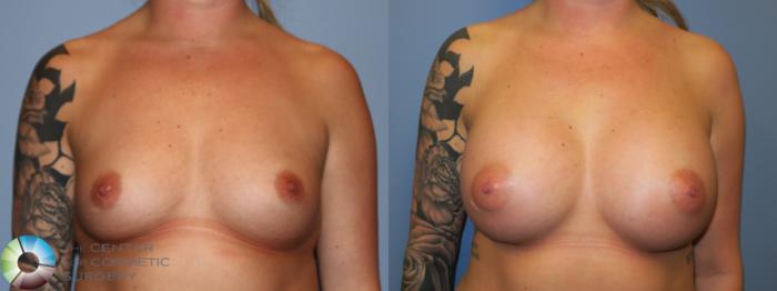 Before & After Breast Augmentation Case 11668 Front View in Golden, CO
