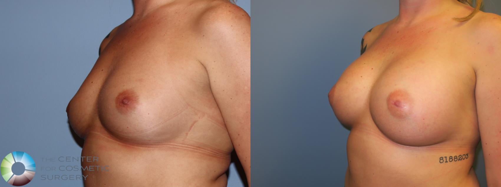 Before & After Breast Augmentation Case 11668 Left Oblique in Denver and Colorado Springs, CO
