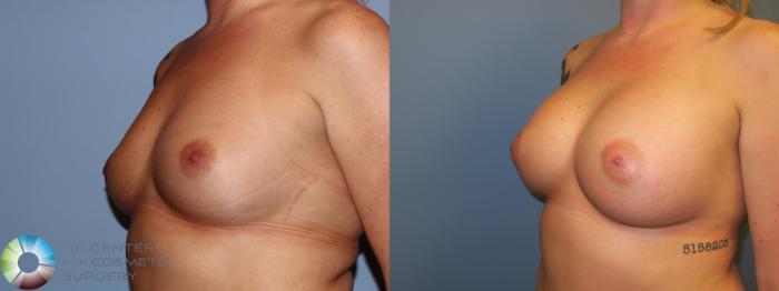 Before & After Breast Augmentation Case 11668 Left Oblique View in Golden, CO