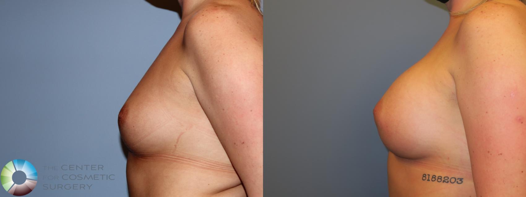 Before & After Breast Augmentation Case 11668 Left Side in Denver and Colorado Springs, CO