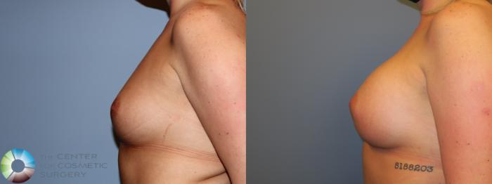 Before & After Breast Augmentation Case 11668 Left Side View in Golden, CO