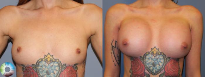 Before & After Breast Augmentation Case 11669 Front in Denver and Colorado Springs, CO