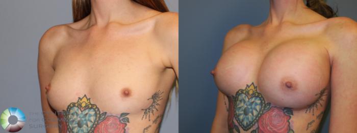 Before & After Breast Augmentation Case 11669 Left Oblique in Denver and Colorado Springs, CO