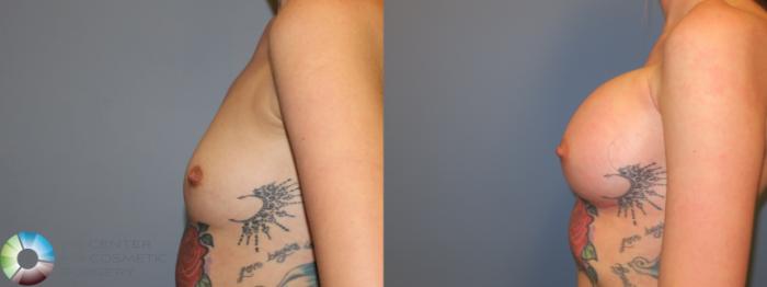 Before & After Breast Augmentation Case 11669 Left Side in Denver and Colorado Springs, CO