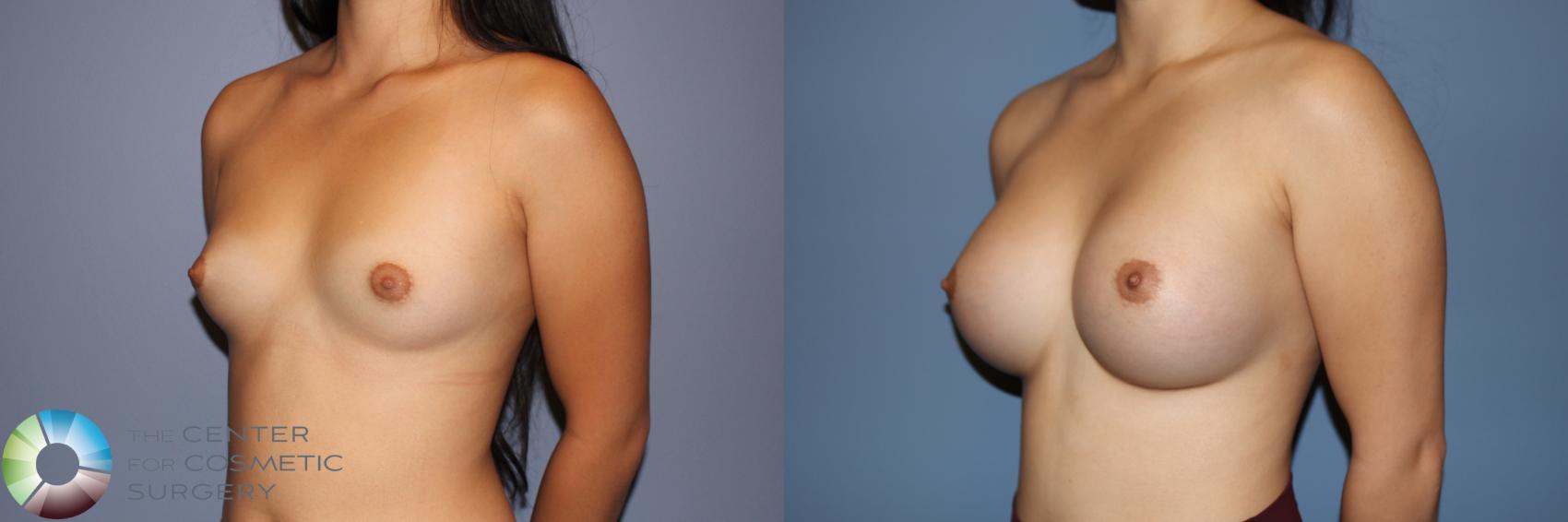 Before & After Breast Augmentation Case 11670 Left Oblique in Denver and Colorado Springs, CO