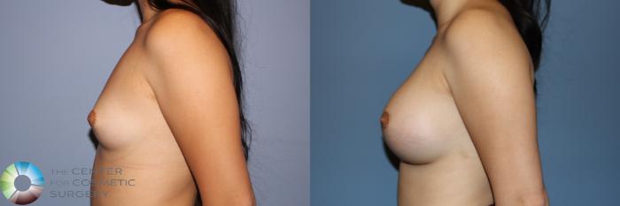 Before & After Breast Augmentation Case 11670 Left Side View in Golden, CO