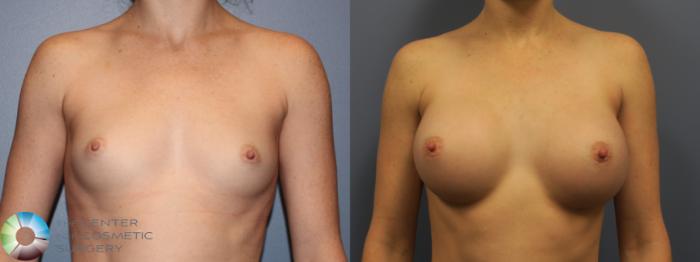 Before & After Breast Augmentation Case 11673 Front View in Golden, CO