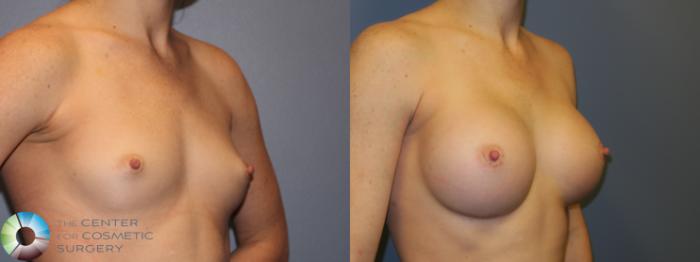 Before & After Breast Augmentation Case 11673 Right Oblique View in Golden, CO