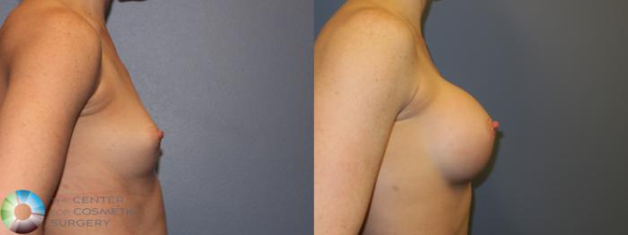Before & After Breast Augmentation Case 11673 Right Side View in Golden, CO