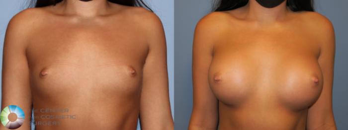 Before & After Breast Augmentation Case 11676 Front View in Golden, CO
