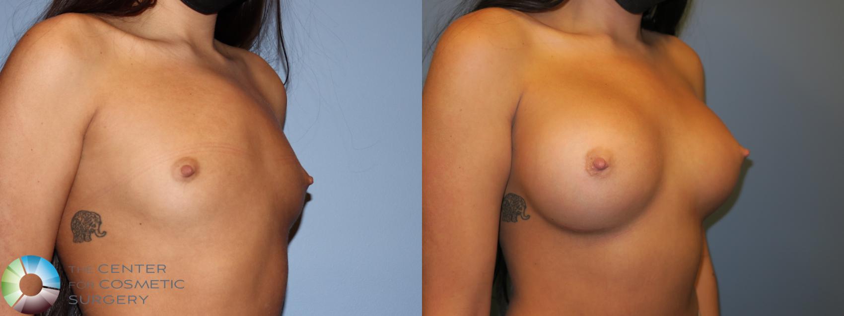 Before & After Breast Augmentation Case 11676 Right Oblique View in Golden, CO
