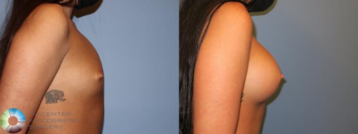 Before & After Breast Augmentation Case 11676 Right Side View in Golden, CO