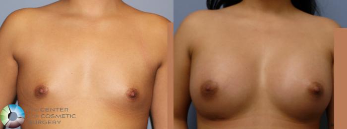 Before & After Breast Augmentation Case 11678 Front View in Golden, CO