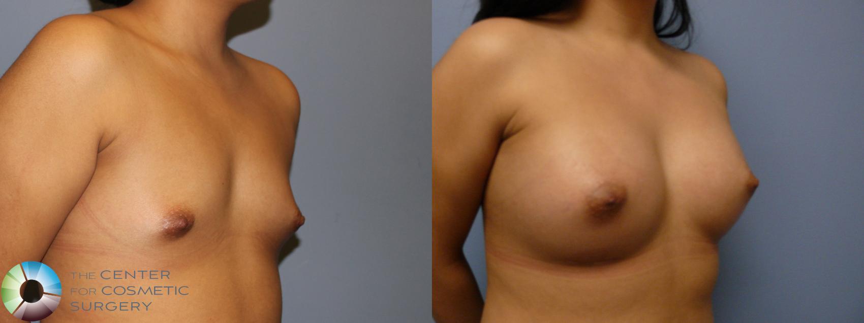 Before & After Breast Augmentation Case 11678 Right Oblique View in Golden, CO