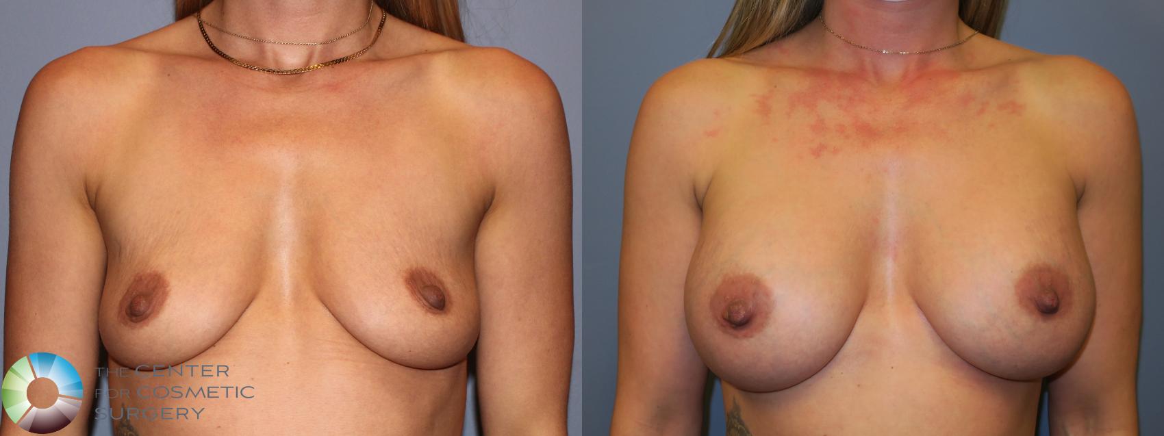 Before & After Breast Augmentation Case 11679 Front in Denver and Colorado Springs, CO