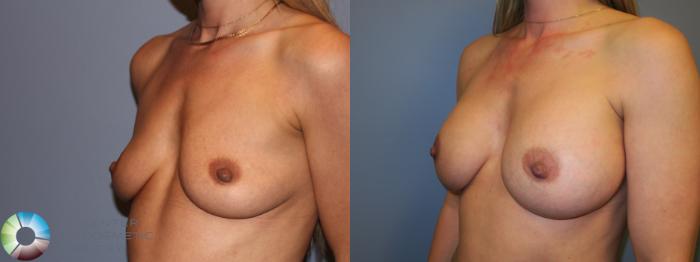 Before & After Breast Augmentation Case 11679 Left Oblique in Denver, CO