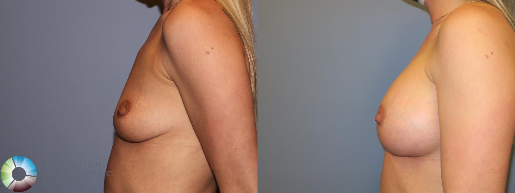 Before & After Breast Augmentation Case 11679 Left Side in Denver and Colorado Springs, CO