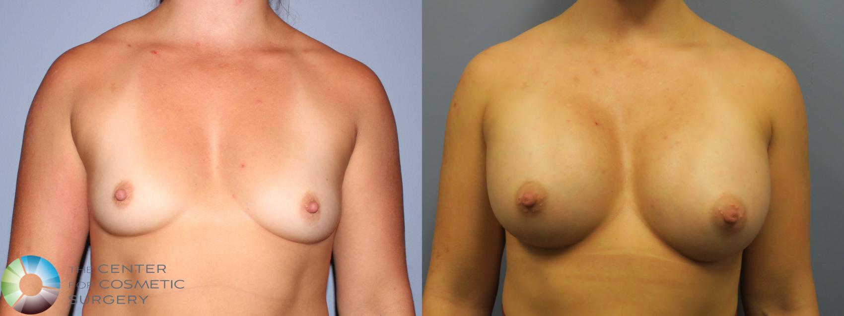 Before & After Breast Augmentation Case 11680 Front in Denver and Colorado Springs, CO