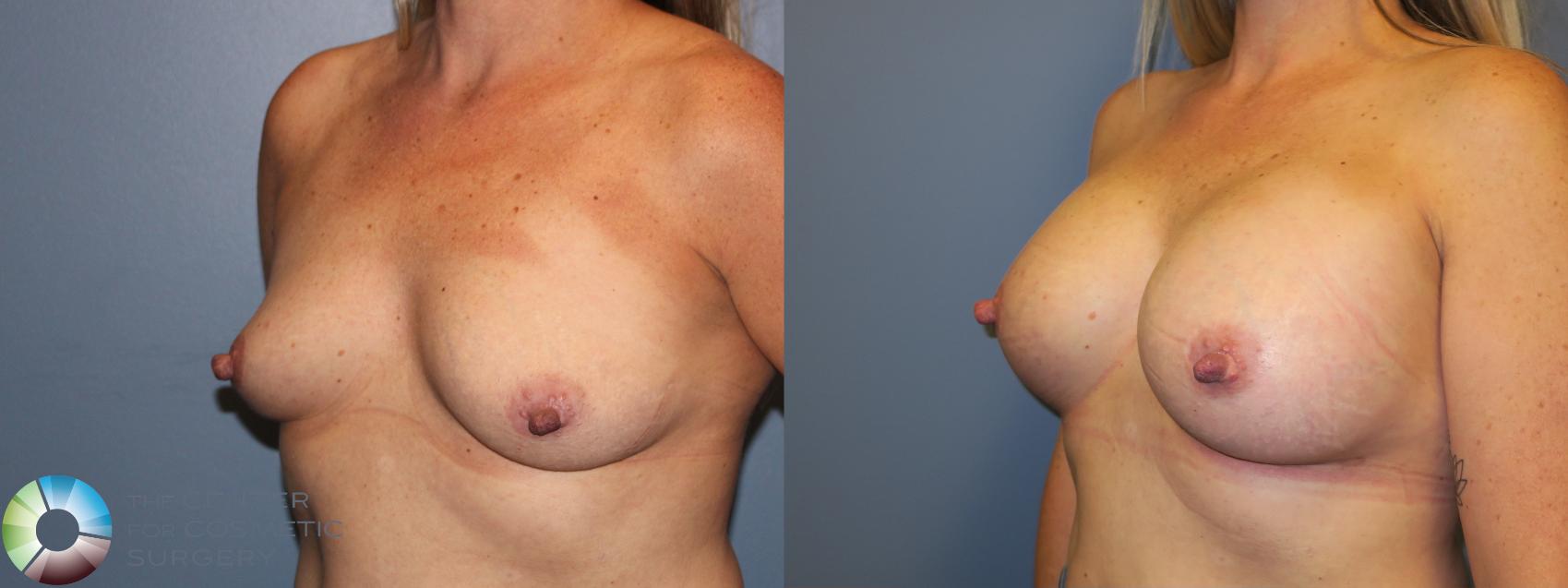 Before & After Breast Augmentation Case 11681 Left Oblique in Denver and Colorado Springs, CO