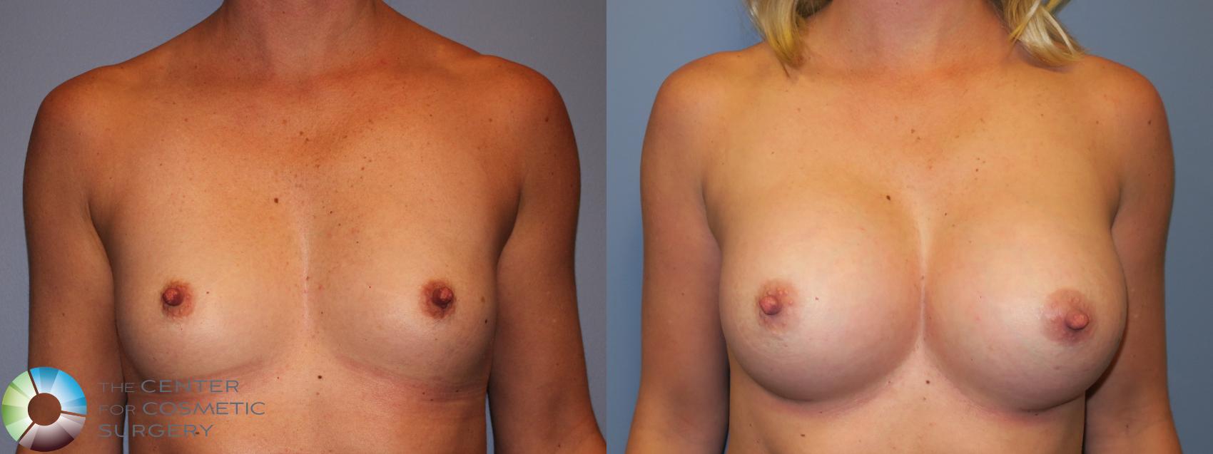 Before & After Breast Augmentation Case 11682 Front in Denver and Colorado Springs, CO