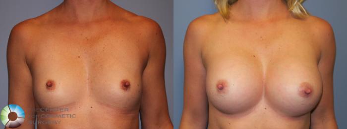 Before & After Breast Augmentation Case 11682 Front in Denver and Colorado Springs, CO