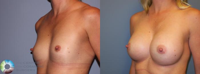 Before & After Breast Augmentation Case 11682 Left Oblique in Denver and Colorado Springs, CO