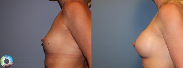 Before & After Breast Augmentation Case 11682 Left Side in Denver and Colorado Springs, CO