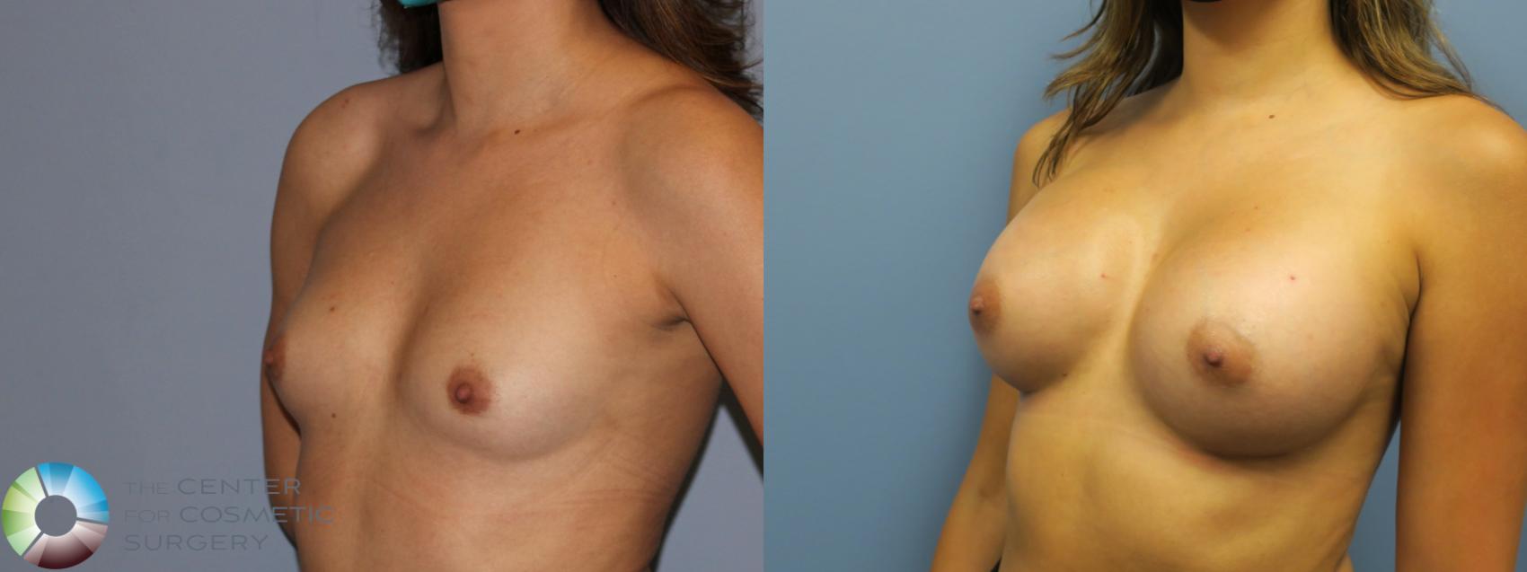 Before & After Breast Augmentation Case 11691 Left Oblique in Denver and Colorado Springs, CO