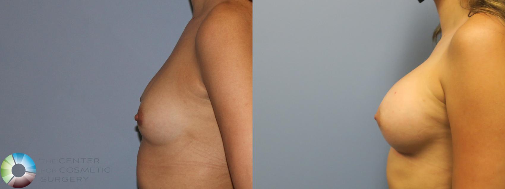 Before & After Breast Augmentation Case 11691 Left Side in Denver and Colorado Springs, CO