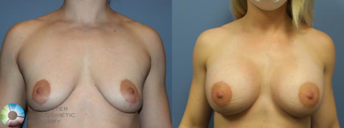 Before & After Breast Augmentation Case 11692 Front View in Golden, CO