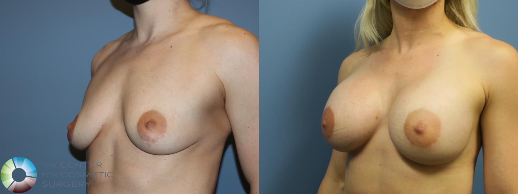 Before & After Breast Augmentation Case 11692 Right Oblique in Denver and Colorado Springs, CO