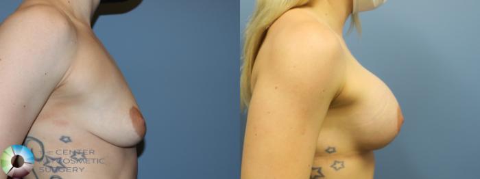 Before & After Breast Augmentation Case 11692 Right Side View in Golden, CO