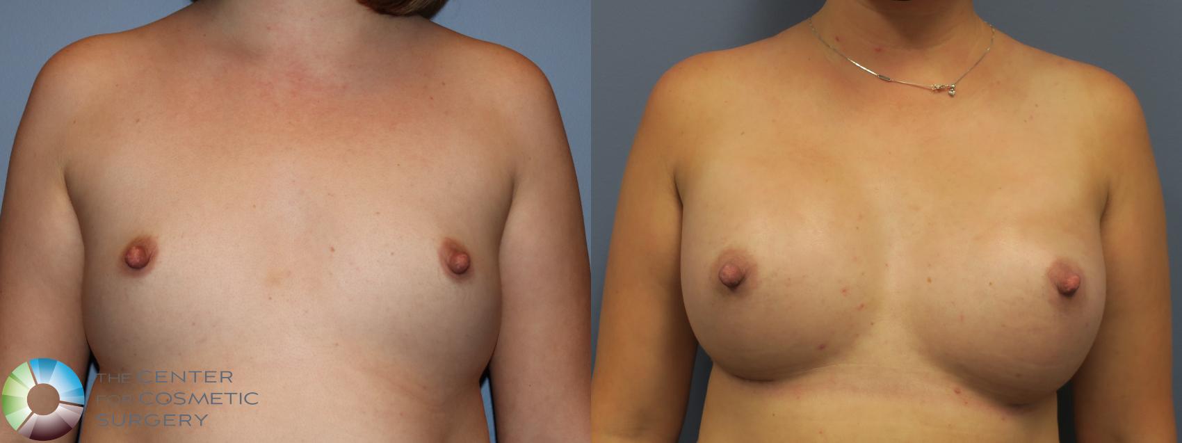 Before & After Breast Augmentation Case 11701 Front in Denver and Colorado Springs, CO