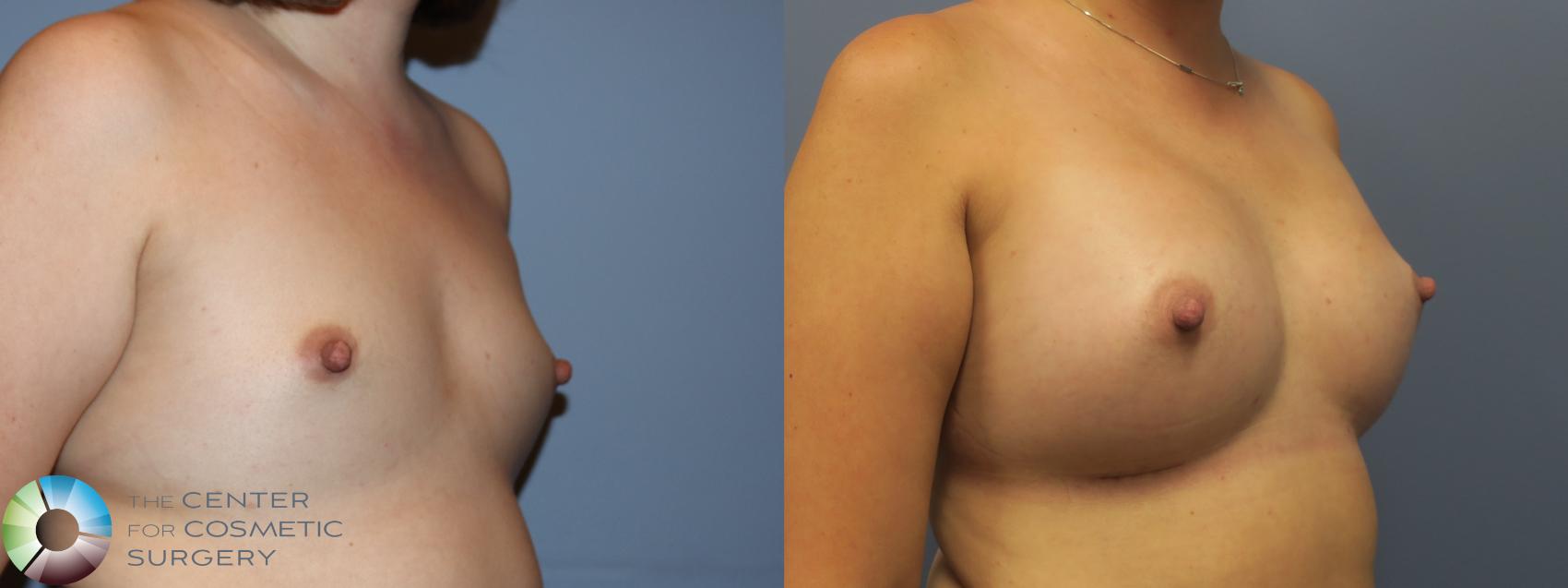 Before & After Breast Augmentation Case 11701 Right Oblique in Denver and Colorado Springs, CO