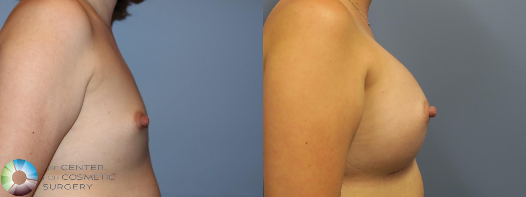 Before & After Breast Augmentation Case 11701 Right Side in Denver and Colorado Springs, CO