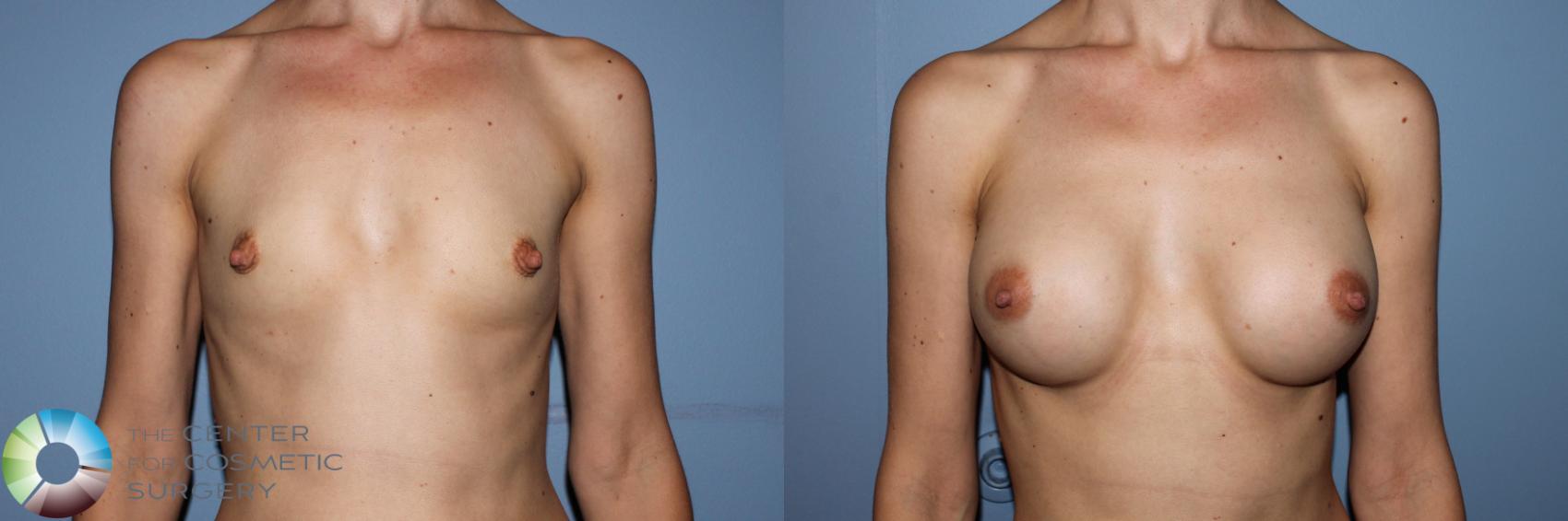 Before & After Breast Augmentation Case 11703 Front View in Golden, CO